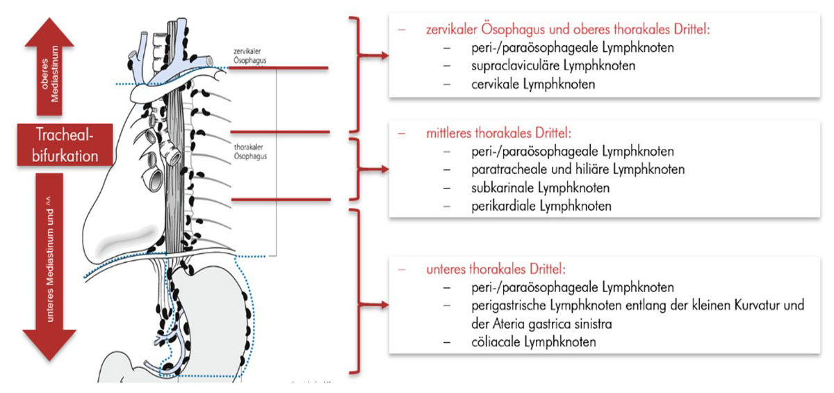 Darstellung der verschiedenen Lymphknotenstationen der Speiseröhre