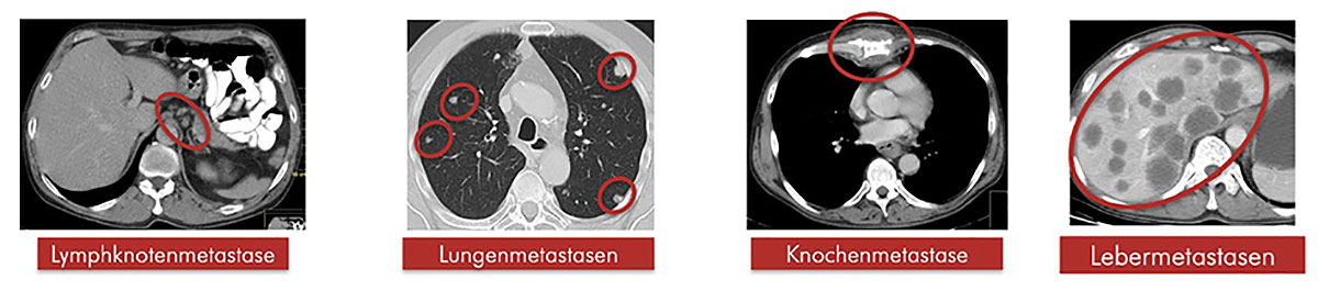 Beispielbilder für die typische Ausbreitung der Tumorzellen des Barrett-Karzinoms